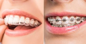 Read more about the article Invisalign vs. Braces: Choosing the Best Option for Your Smile
