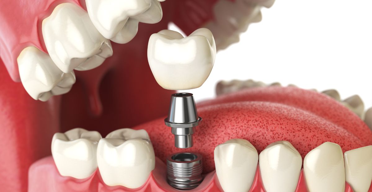 Read more about the article Dental Implants: The Permanent Solution for Missing Teeth