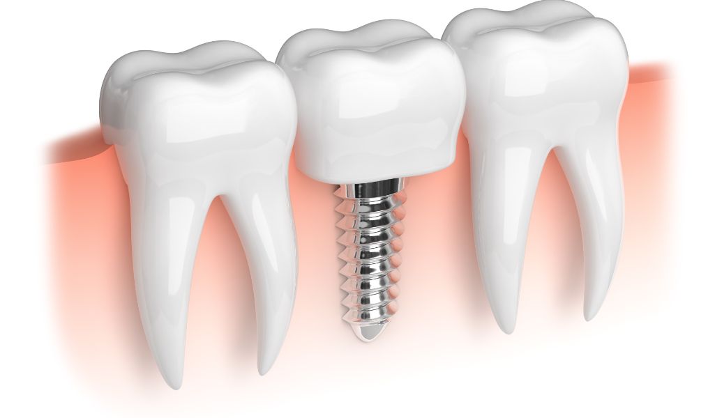 Invest in Your Smile with Dental Implants