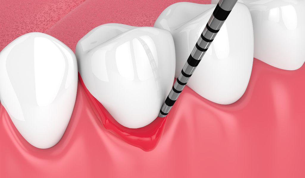 What Is Gum Surgery