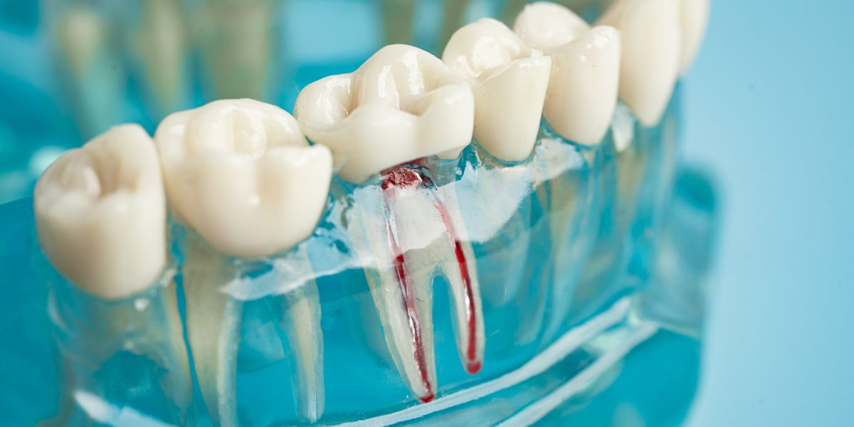 Read more about the article Busting Common Myths About Root Canal Treatment: What’s True and What’s Not