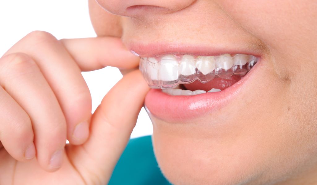 Clear Aligners as Retainers