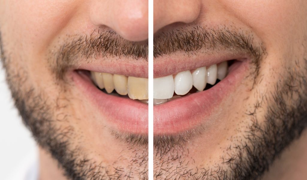 Common Procedures Involved in a Smile Makeover-Teeth Whitening