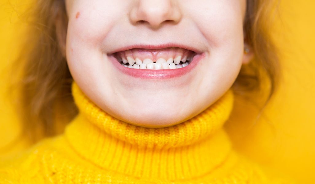 Fixing an Underbite with Invisalign