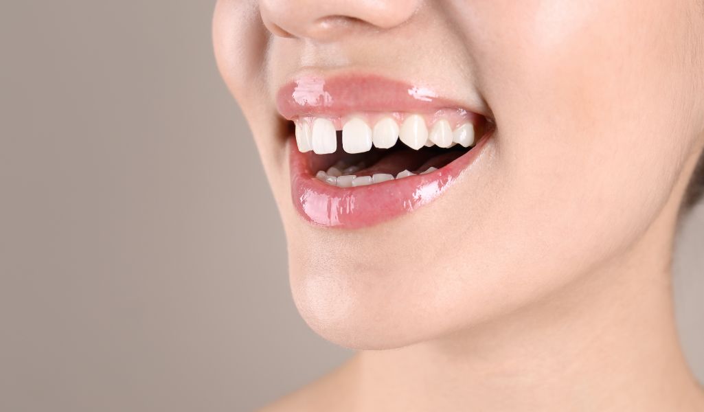 Invisalign Solves Complex Dental Problems- 2. Spacing Problems (Gaps Between Teeth)​