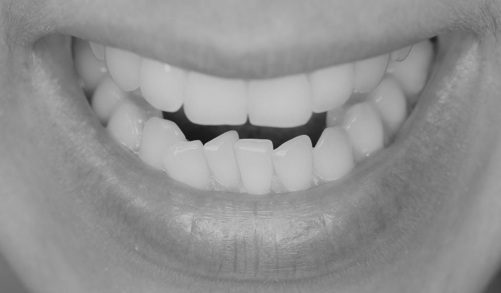 Invisalign Solves Complex Dental Problems- Teeth Crowding