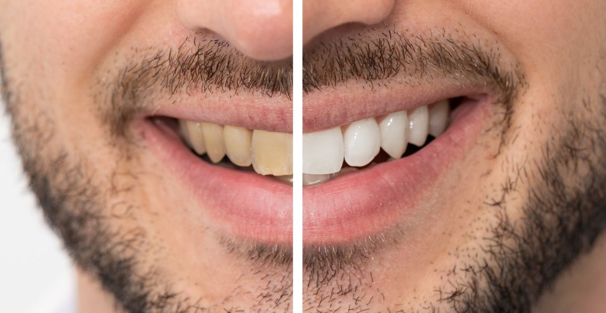 Read more about the article Unlock a Healthier Smile: The Importance of Oral Prophylaxis for Preventive Care
