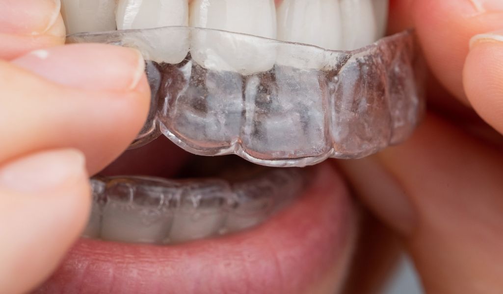 Wear Your Aligners Consistently