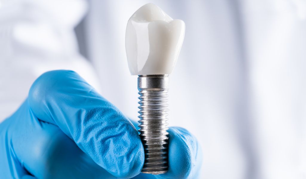 What Are Dental Implants