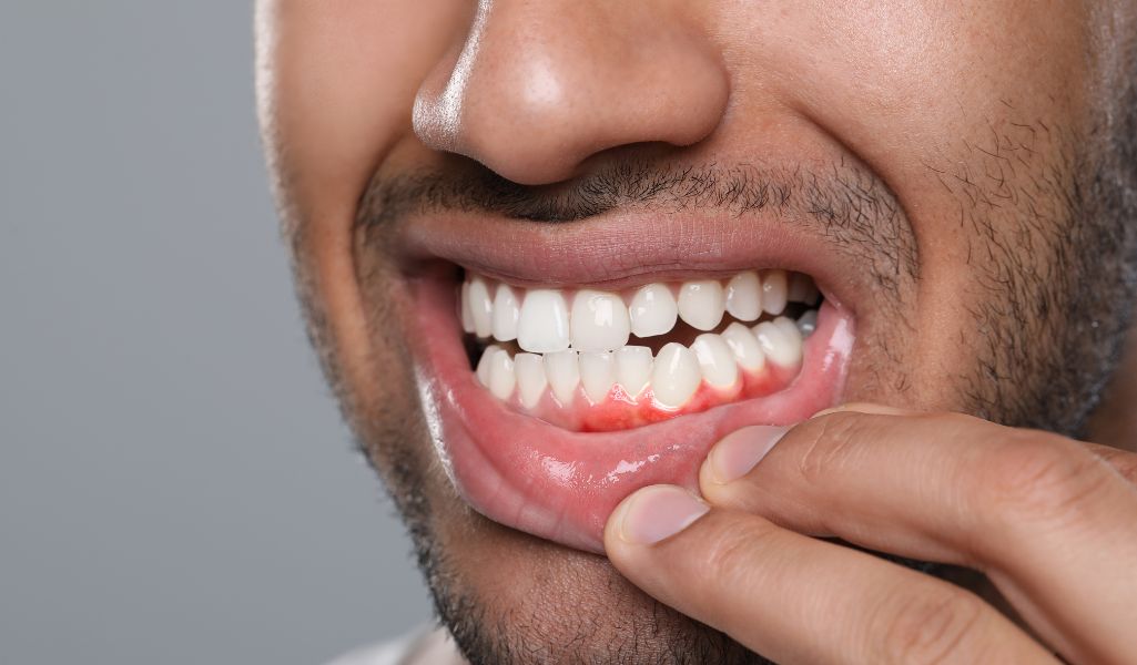 Why Oral Prophylaxis Matters-Prevents Gum Disease