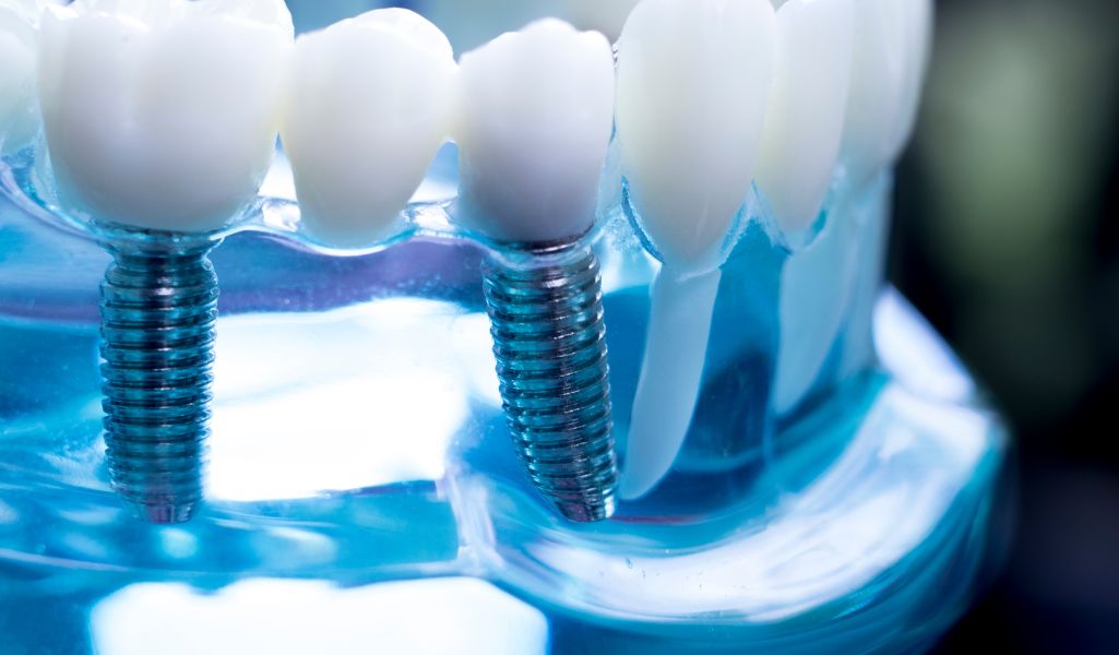 Dental Implants A Permanent Solution for Missing Teeth