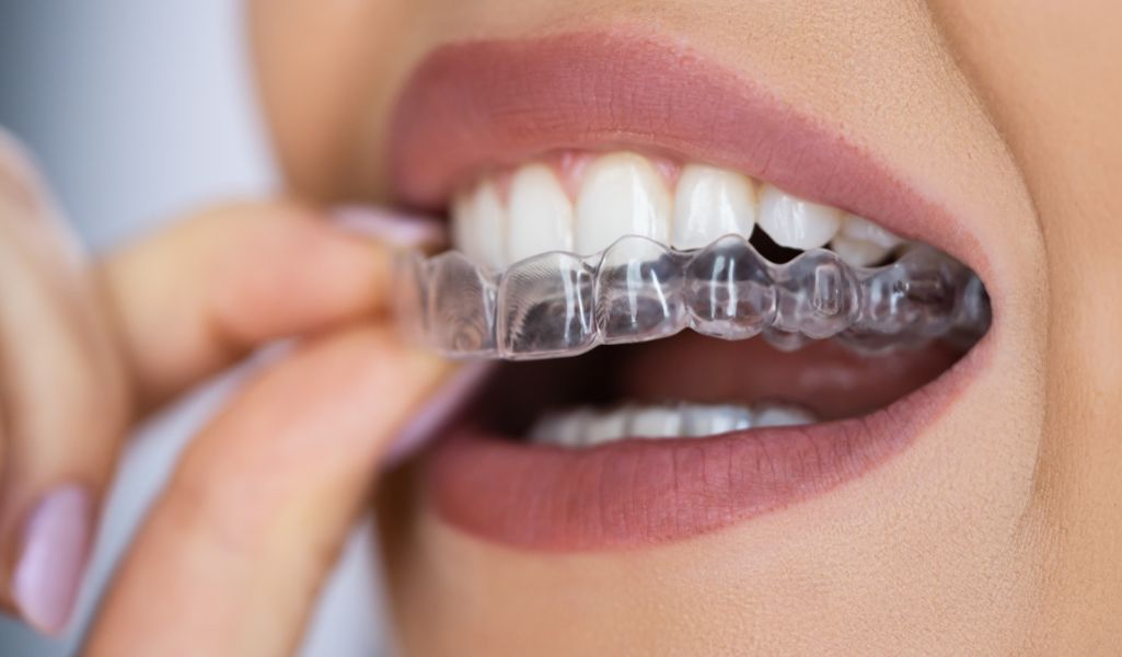 Failure to Wear Aligners Consistently