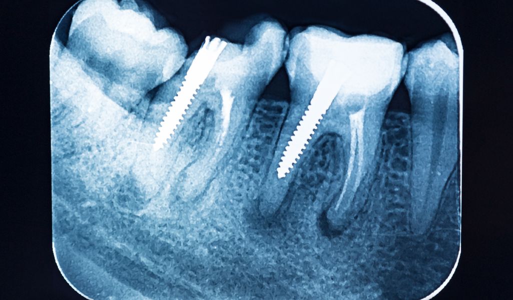 Faster and More Accurate Diagnoses with Digital X-Rays