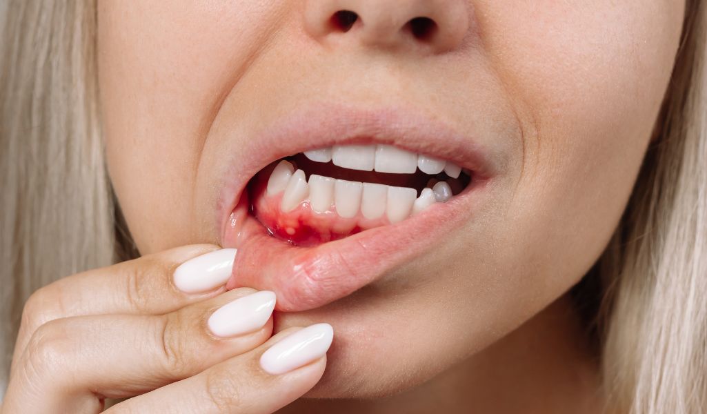 Gum Contouring Perfecting Your Gums