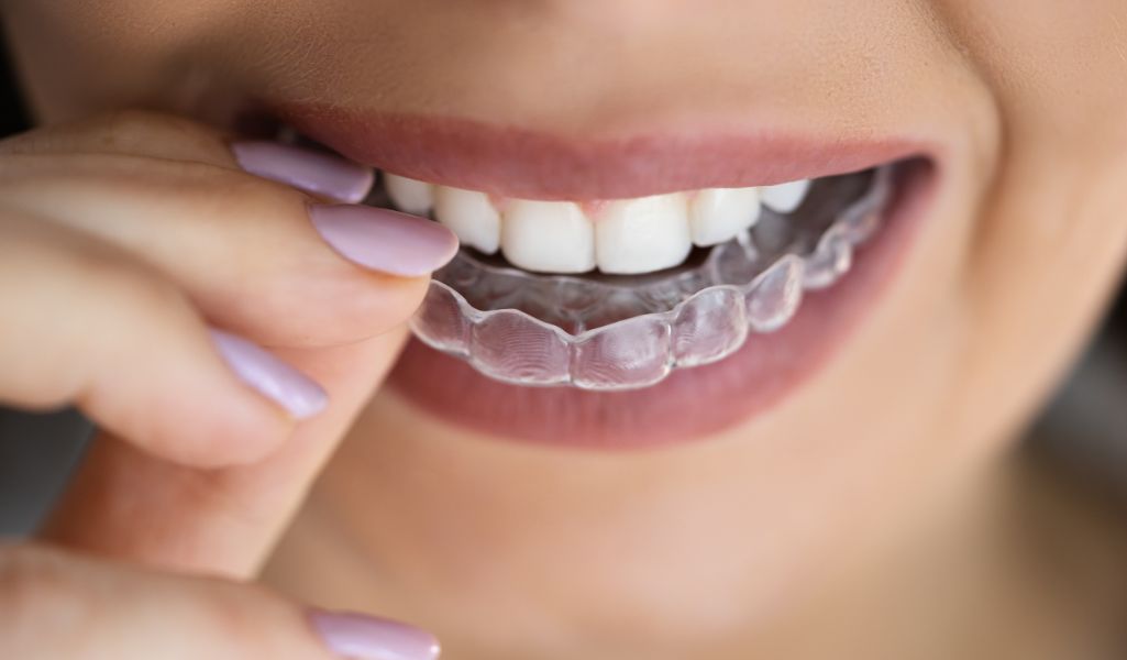 Incorporate Clear Aligners into Your Daily Routine