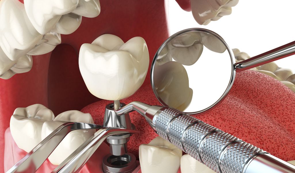 Popular Restorative Dentistry Treatments That Can Change Your Life-Dental Implants