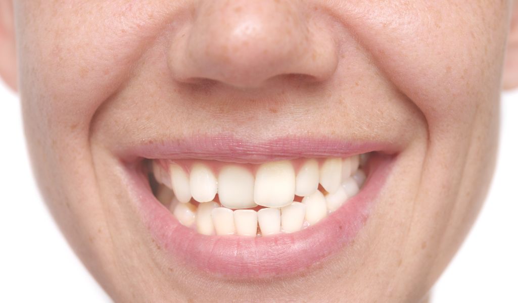 Preventing Overcrowding and Teeth Shifting