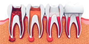 Read more about the article Root Canal Treatment Demystified: The Surprising Benefits Beyond Pain Relief