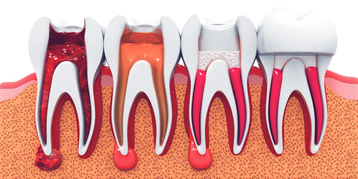 Read more about the article Root Canal Treatment Demystified: The Surprising Benefits Beyond Pain Relief