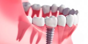Read more about the article Unlocking the Secrets of Dental Implants: Discover the Best Type and Procedure for Your Perfect Smile